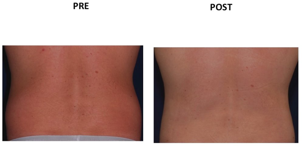 FIANCHI
VASER LIPO