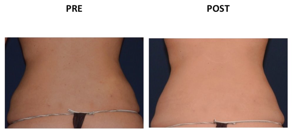 FIANCHI
VASER LIPO
