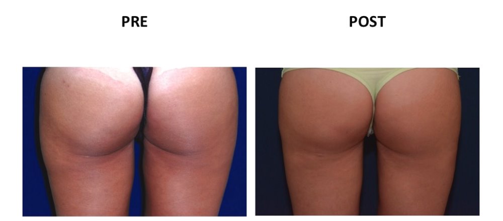 GLUTEI
VASER LIPO