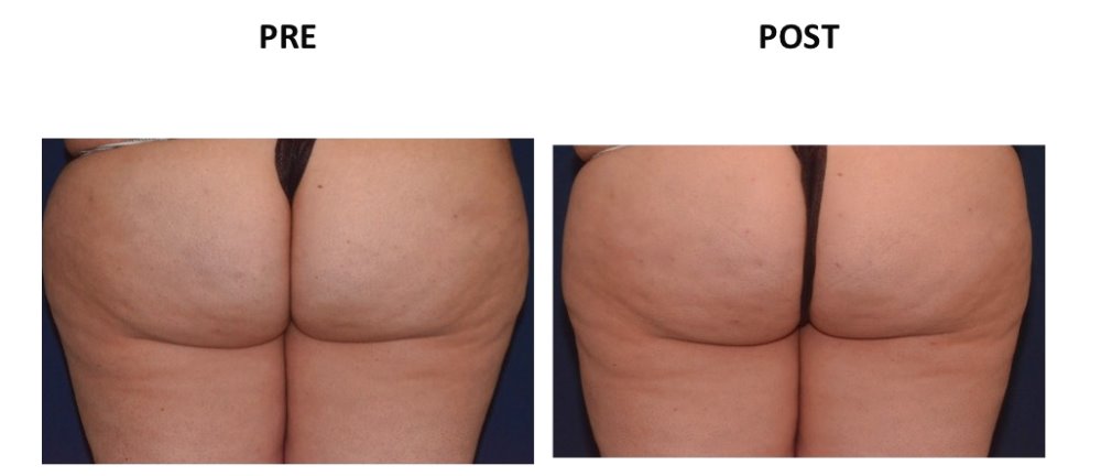ESTERNO COSCE
VASER LIPO